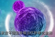石家庄干细胞移植治疗肝硬化案例