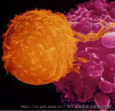 广州干细胞是怎么移植到人体