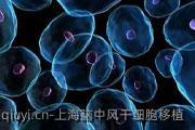 上海脑中风干细胞移植