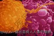 脑出血病人人体干细胞