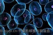 干细胞移植与脑溢血